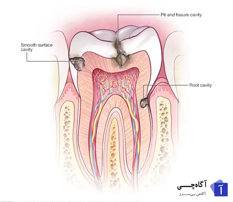 انسداد شیارهای دندانی