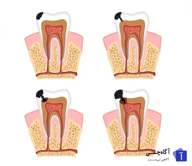 پوسیدگی ریشه دندان