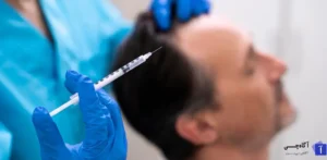 کاشت مو یکی از روش های مؤثر برای درمان ریزش مو و استعاده ظاهر طبیعی است. این عمل به افراد کمک می‌کند تا موهای خود را بازیابند