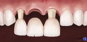 بریج دندانی چیست؟