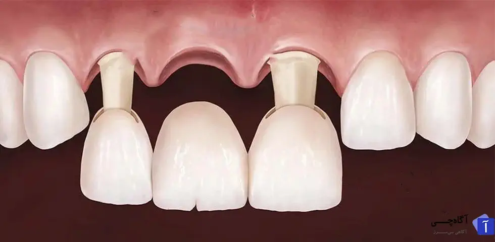 بریج دندانی چیست؟