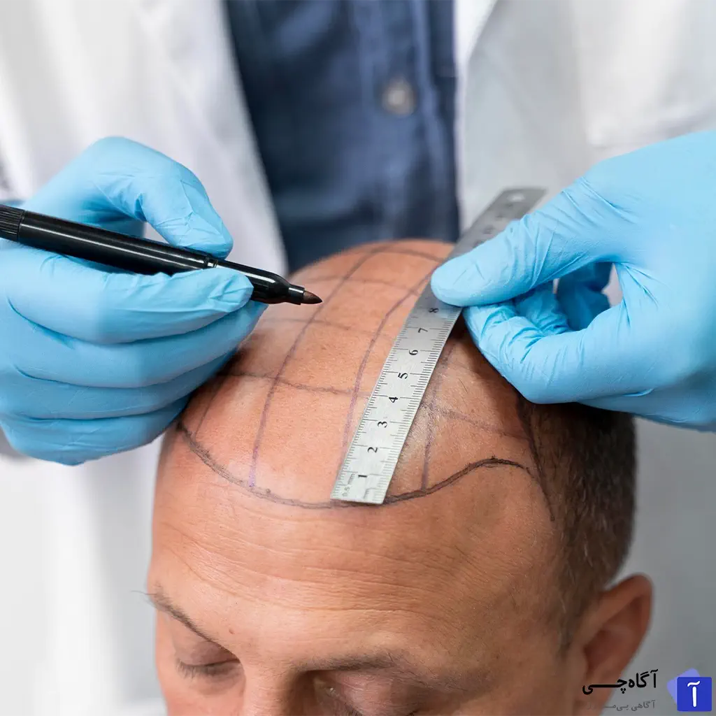  یکی از بزرگ ترین مزایای کاشت مو طبیعی، نتایج دائمی و ظاهری طبیعی آن است