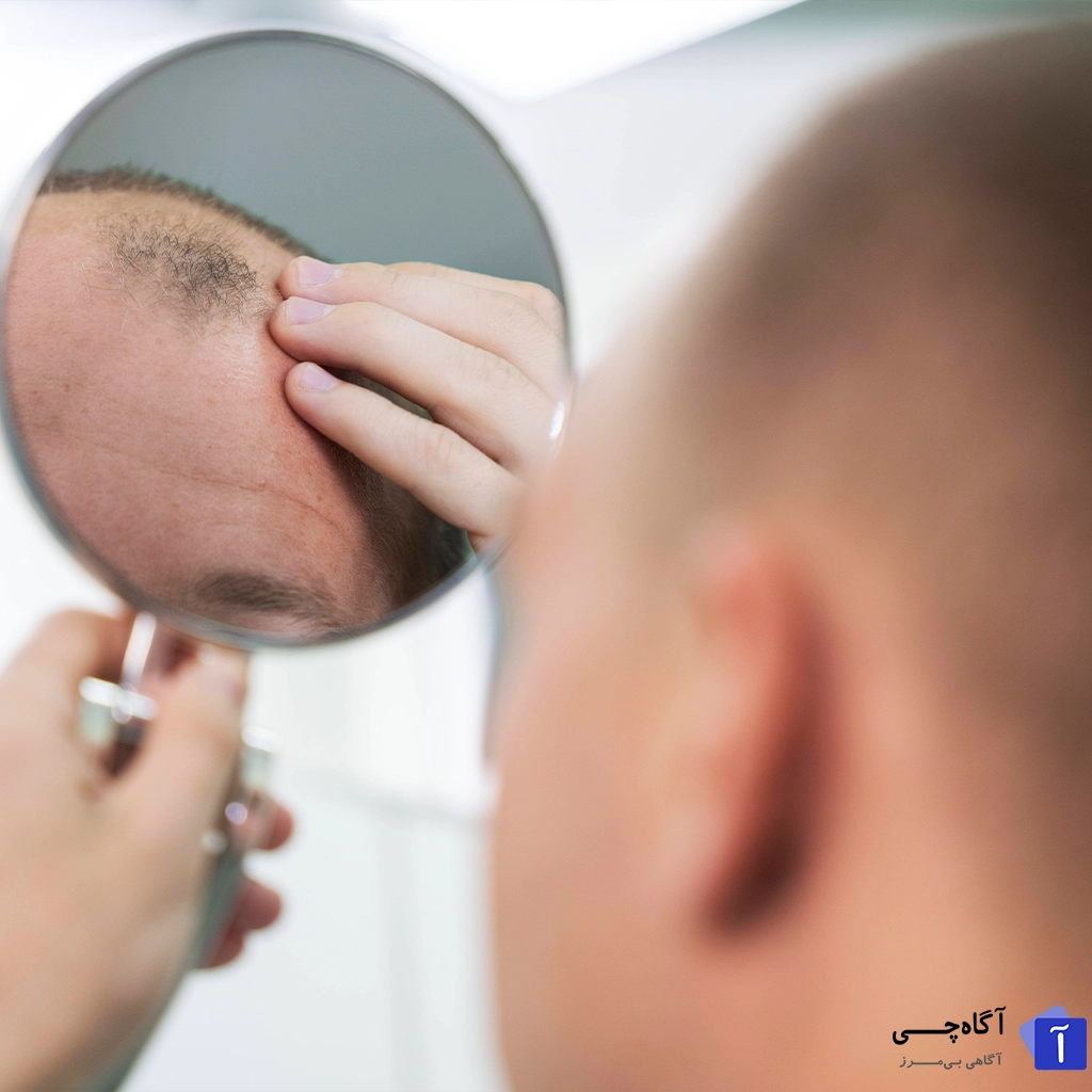 کنترل هورمون ها برای بهبود نتیجه کاشت مو