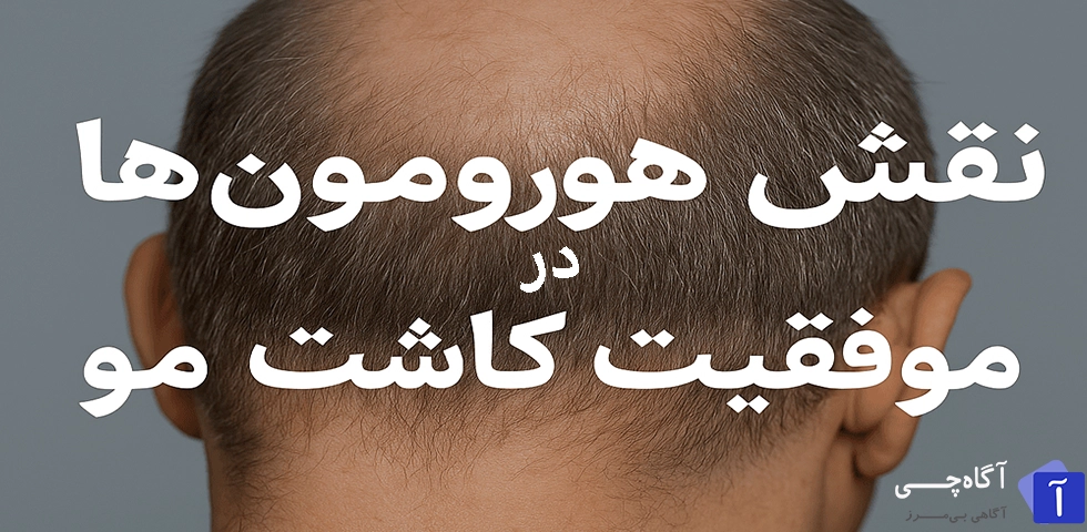 کاشت مو یک روش محبوب و مؤثر برای درمان ریزش مو، به ویژه در افرادی است که از طاسی ارثی رنج می‌برند.